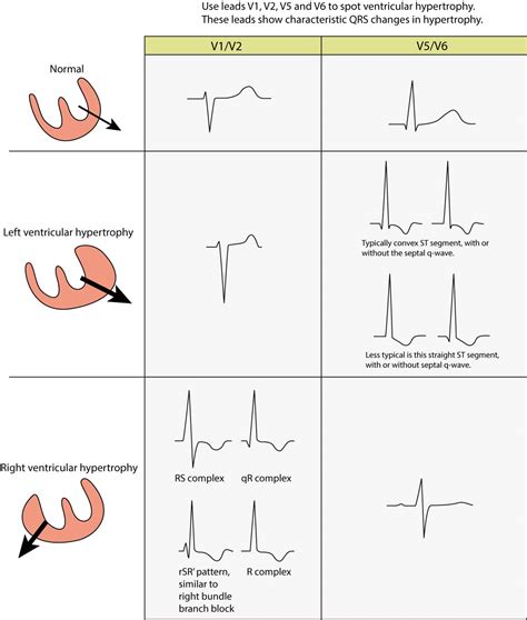 lvh signs on ecg.